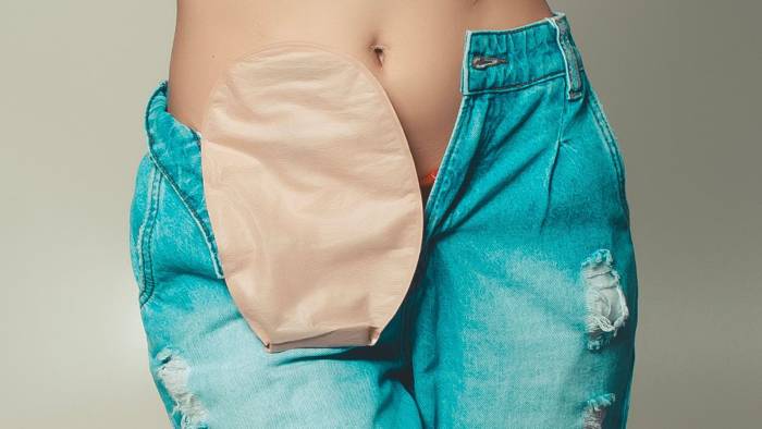 Bijeenkomst Adrz staat stil bij leven met een stoma